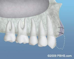 A depiction of the placed bone grafting material to increase the bone structure