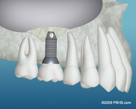 An example of a dental implant after adding jaw structure with bone grafting