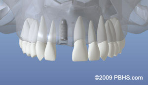 A digital representation of the initial dental implant placed in the jaw bone