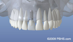 An example of a fully restored tooth using a dental implant