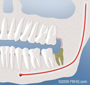 A visual of dry socket that developed after the removal of wisdom teeth