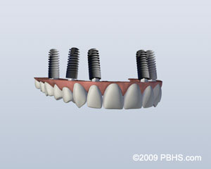 An Implant Retained Upper Denture with its implants attached