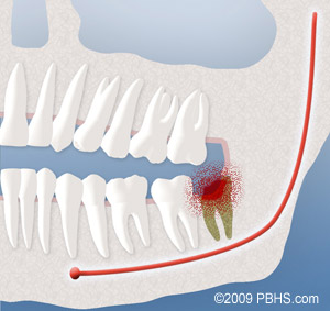 A diagram depicting an infection that occurs after wisdom teeth removal