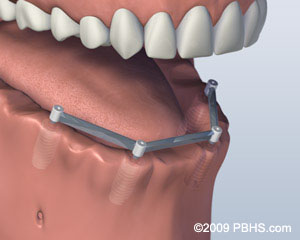 A mouth without teeth and four implants connected by a metal bar on its lower jaw