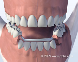 A depiction of a sturdy partial denture cast in metal and plastic