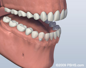 A mouth with a Ball Attachment Denture latched onto the lower jaw by two implants