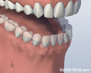 A mouth with a Bar Attachment Denture secured onto the lower jaw by four implants