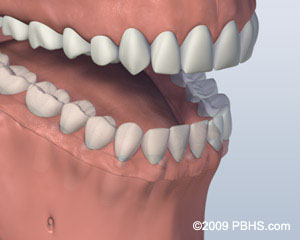 A mouth with a Screw Attachment Denture affixed onto the lower jaw by six implants