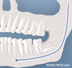 An illustration of a wisdom tooth completely impacted by bone