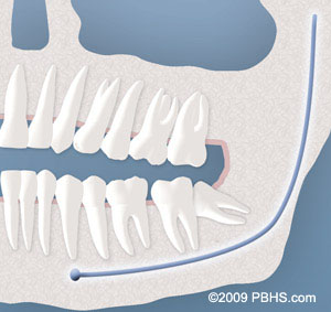A representation of a wisdom tooth impacted by soft tissue