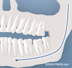 A representation of a wisdom tooth impacted by soft tissue